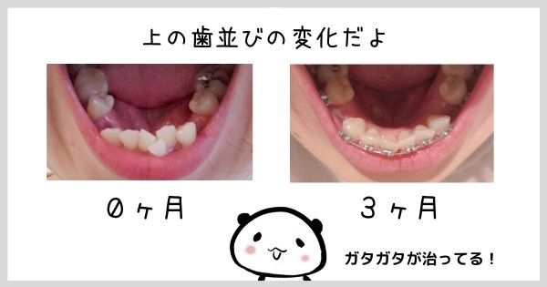 大人の歯列矯正４ すごい ３ヶ月で歯並びはこんなにも変化しました Mar U Home まるホーム のブログ