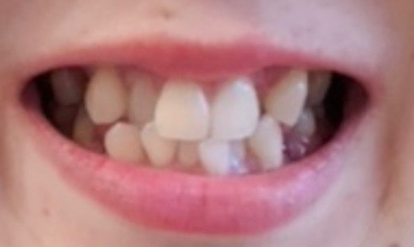 大人の歯列矯正